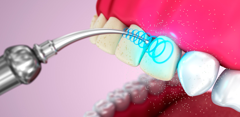 Снятие зубных отложений с использование ультразвука и «Air flow» при винирах и коронках